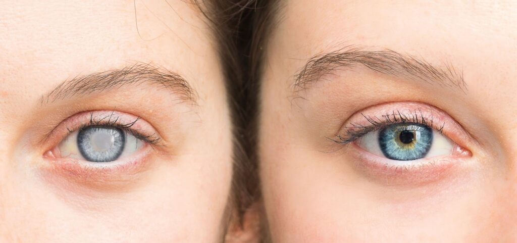 A close-up image comparing a woman's eye with a cataract to an eye without a cataract.